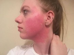 Ex Boots worker who struggled with acne since 10 'wishes she had' their spot cream