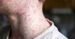 Cases of Victorian-era disease surge in England as 'vital protection' plea issued